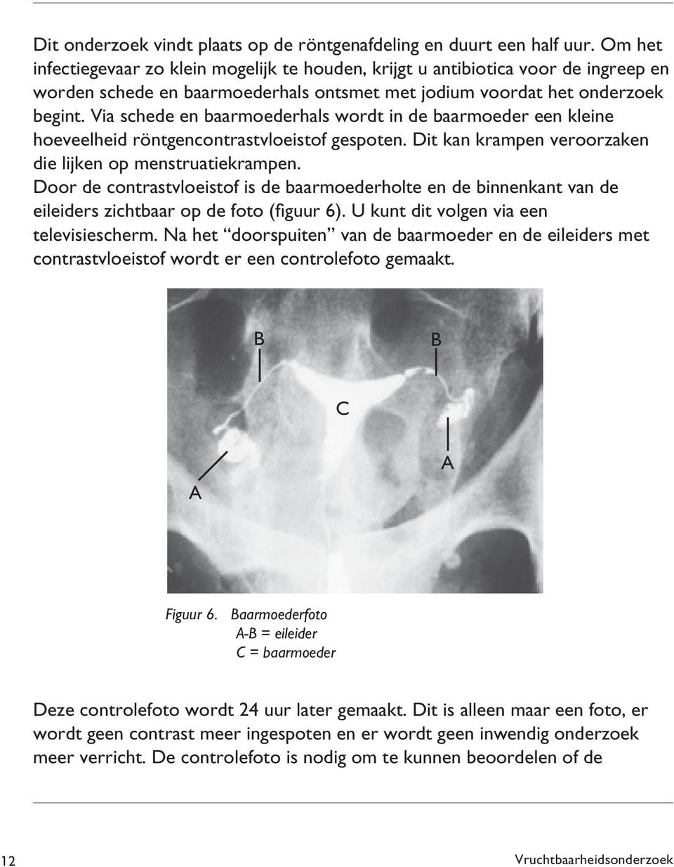 Via schede en baarmoederhals wordt in de baarmoeder een kleine hoeveelheid röntgencontrastvloeistof gespoten. Dit kan krampen veroorzaken die lijken op menstruatiekrampen.