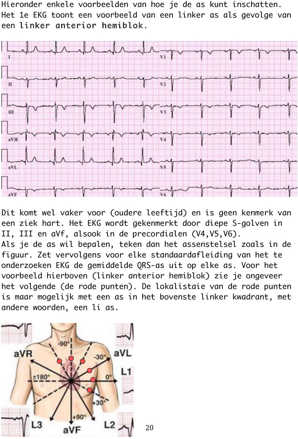 Als je de as wil bepalen, teken dan het assenstelsel zoals in de figuur. Zet vervolgens voor elke standaardafleiding van het te onderzoeken EKG de gemiddelde QRS-as uit op elke as.