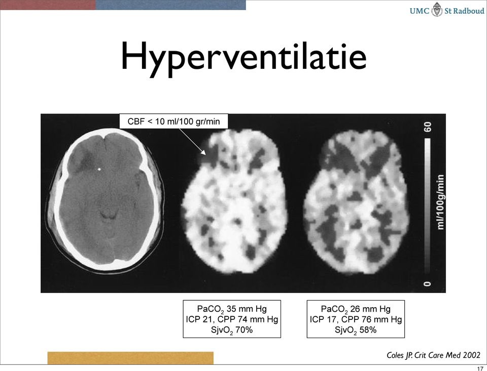 2 70% PaCO 2 26 mm Hg ICP 17, CPP 76 mm