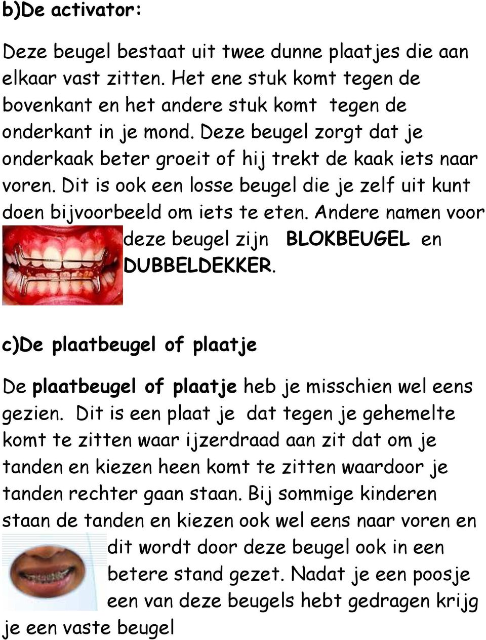 Andere namen voor deze beugel zijn BLOKBEUGEL en DUBBELDEKKER. c)de plaatbeugel of plaatje De plaatbeugel of plaatje heb je misschien wel eens gezien.