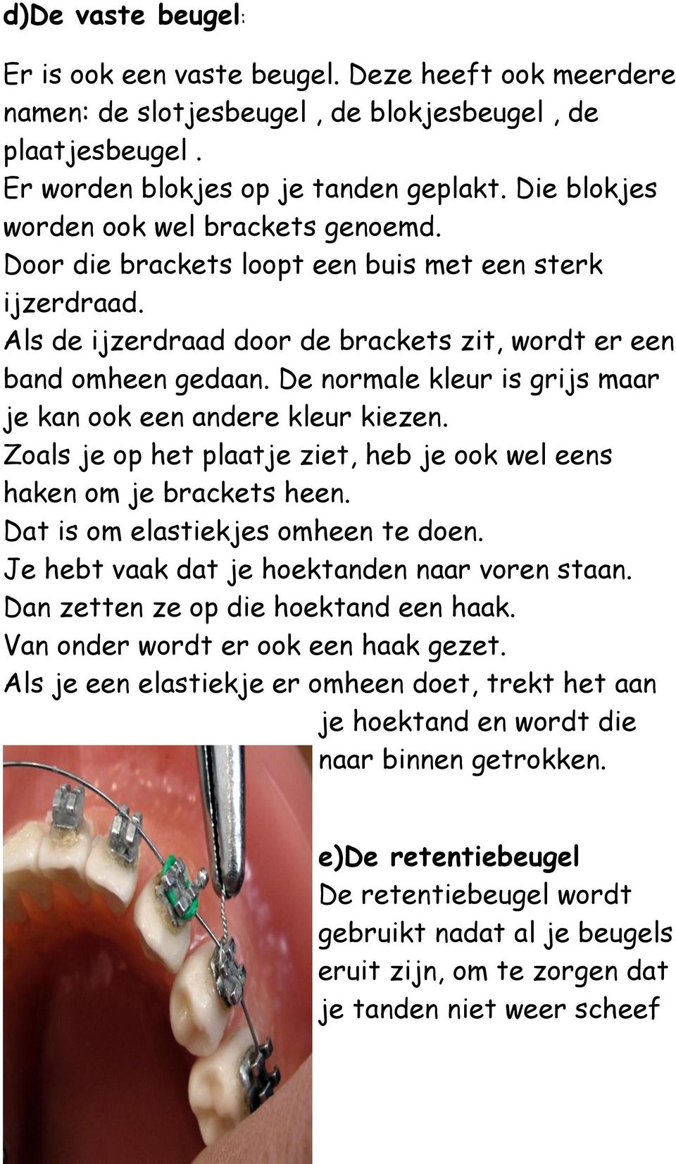 De normale kleur is grijs maar je kan ook een andere kleur kiezen. Zoals je op het plaatje ziet, heb je ook wel eens haken om je brackets heen. Dat is om elastiekjes omheen te doen.