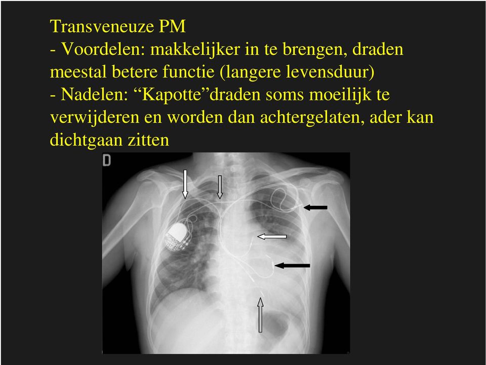 levensduur) - Nadelen: Kapotte draden soms moeilijk