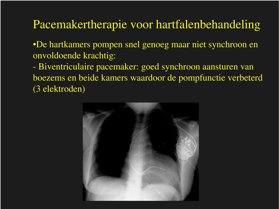 krachtig: - Biventriculaire pacemaker: goed synchroon