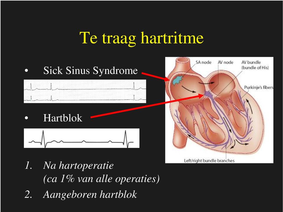 Na hartoperatie (ca 1% van