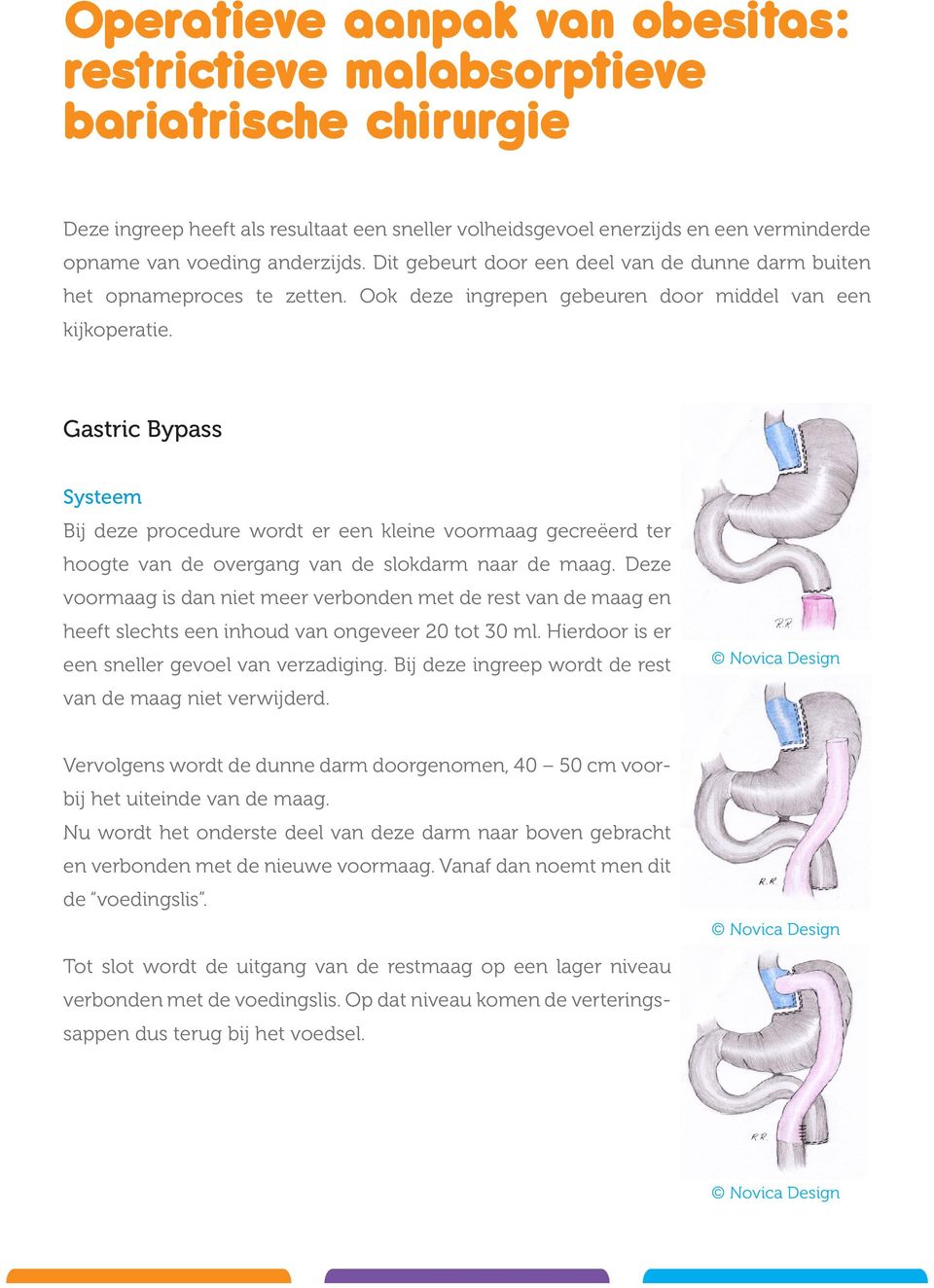 Gastric Bypass Systeem Bij deze procedure wordt er een kleine voormaag gecreëerd ter hoogte van de overgang van de slokdarm naar de maag.