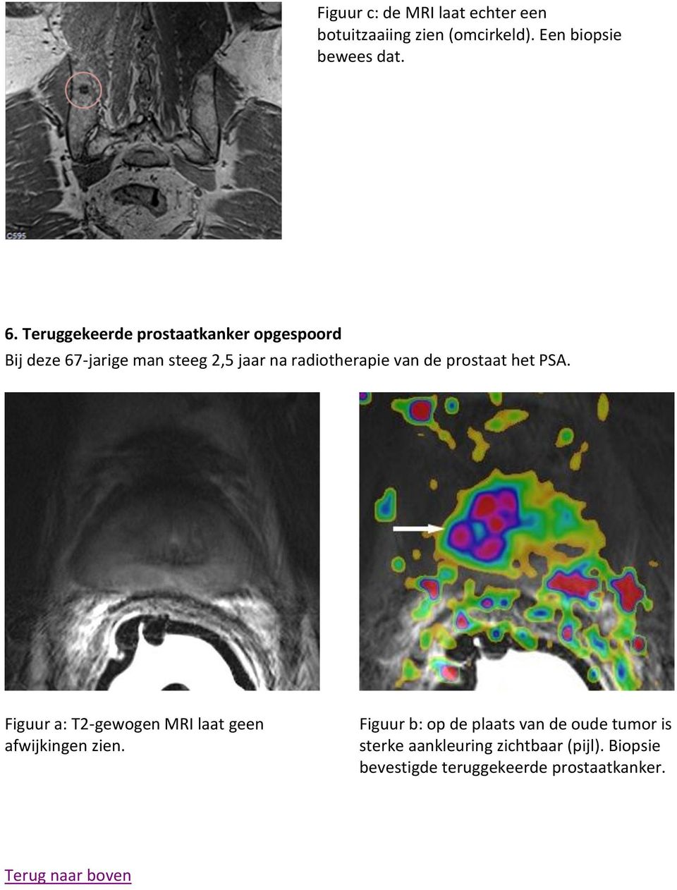 prostaat het PSA. Figuur a: T2-gewogen MRI laat geen afwijkingen zien.