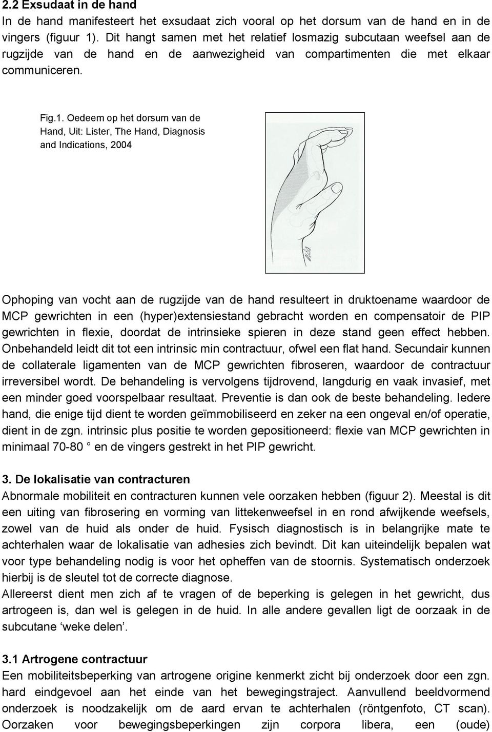 Oedeem op het dorsum van de Hand, Uit: Lister, The Hand, Diagnosis and Indications, 2004 Ophoping van vocht aan de rugzijde van de hand resulteert in druktoename waardoor de MCP gewrichten in een