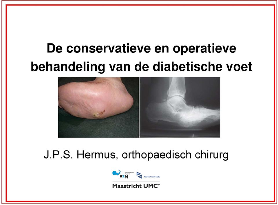 van de diabetische voet J.