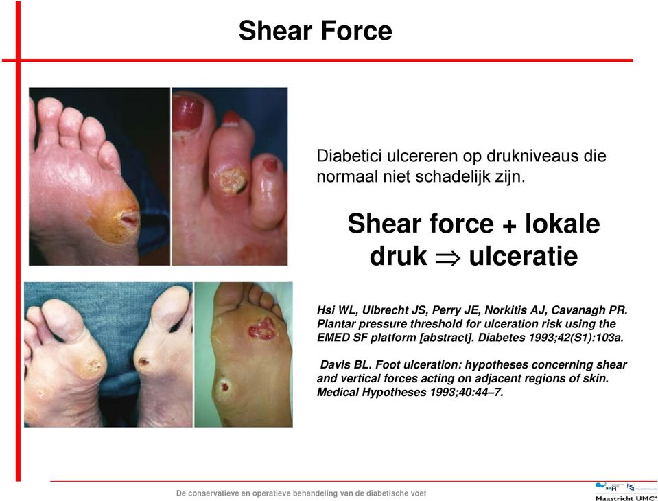 Plantar pressure threshold for ulceration risk using the EMED SF platform [abstract].