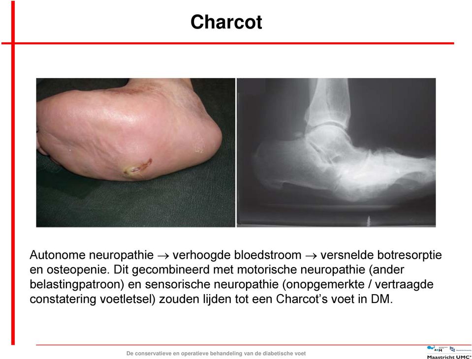 Dit gecombineerd met motorische neuropathie (ander belastingpatroon)