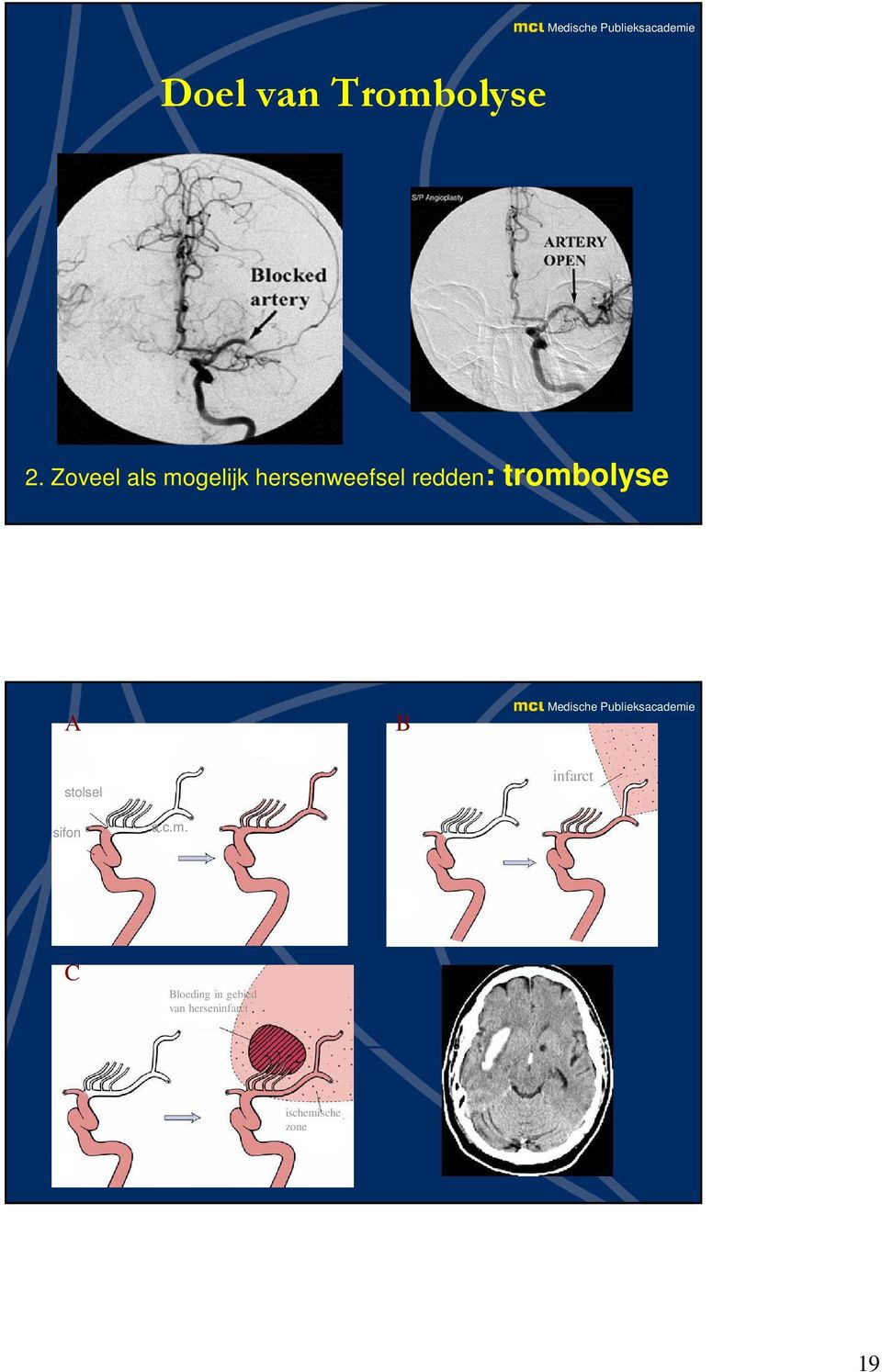 trombolyse A B stolsel infarct sifon