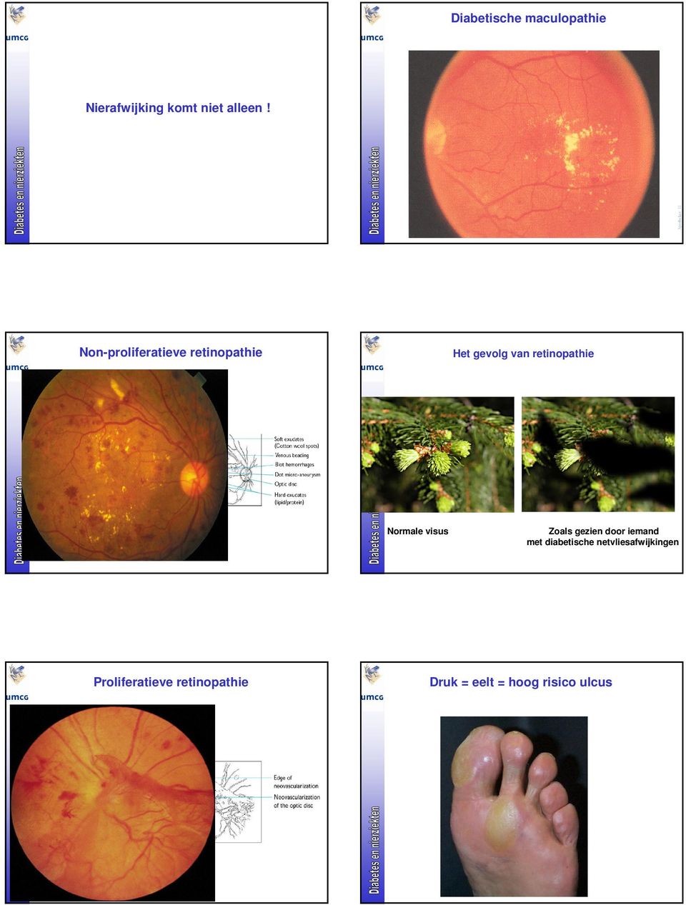 retinopathie Normale visus Zoals gezien door iemand met
