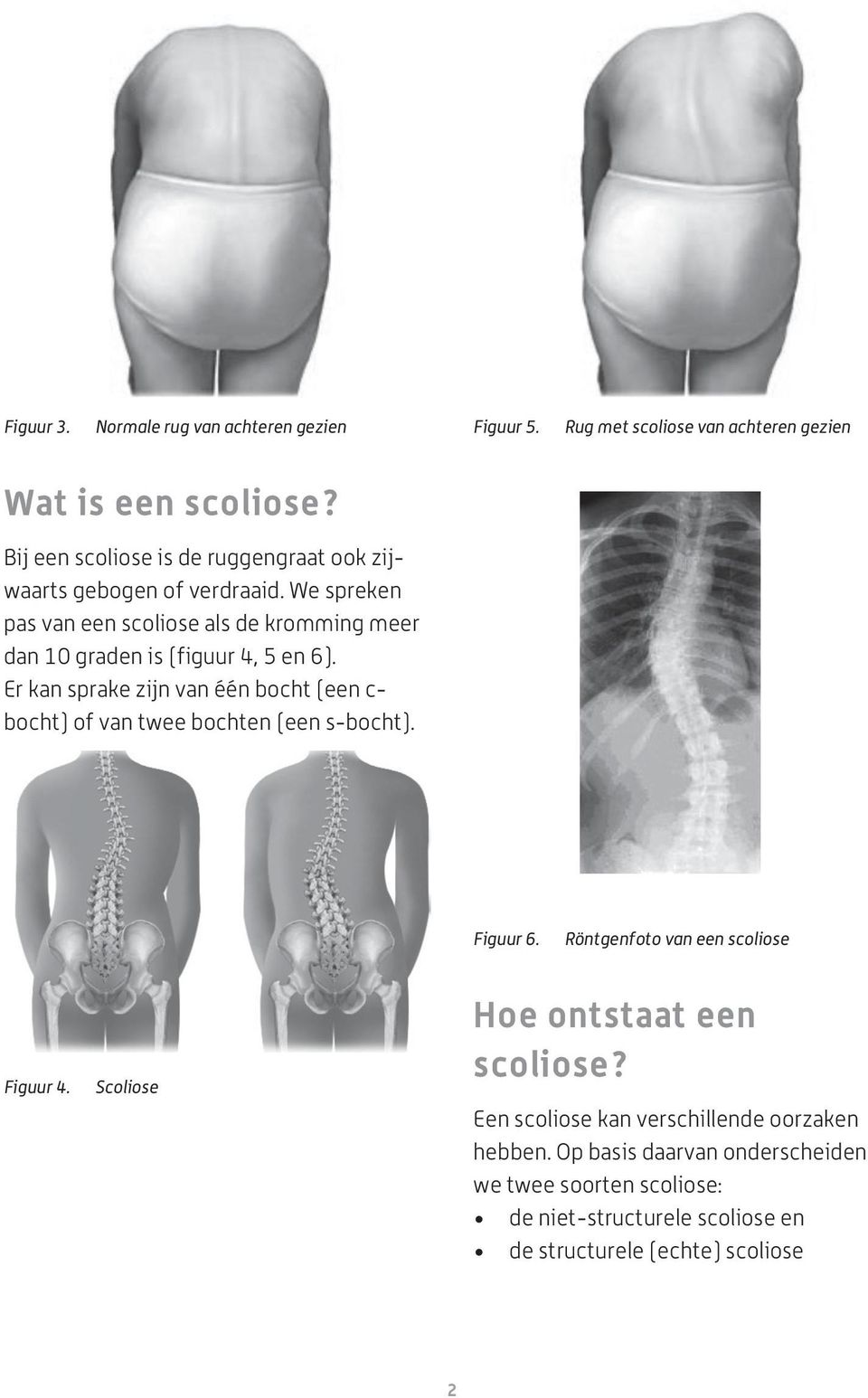 We spreken pas van een scoliose als de kromming meer dan 10 graden is (figuur 4, 5 en 6).