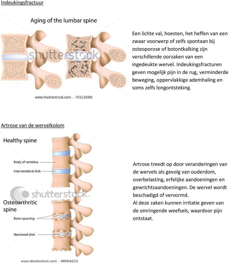 Indeukingsfracturen geven mogelijk pijn in de rug, verminderde beweging, oppervlakkige ademhaling en soms zelfs longontsteking.