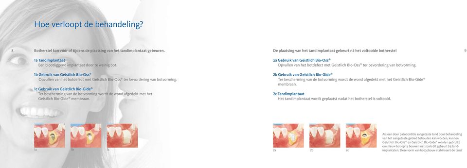 2a Gebruik van Geistlich Bio-Oss Opvullen van het botdefect met Geistlich Bio-Oss ter bevordering van botvorming.