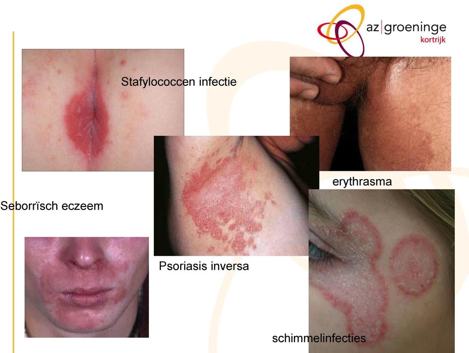 eczeem Psoriasis