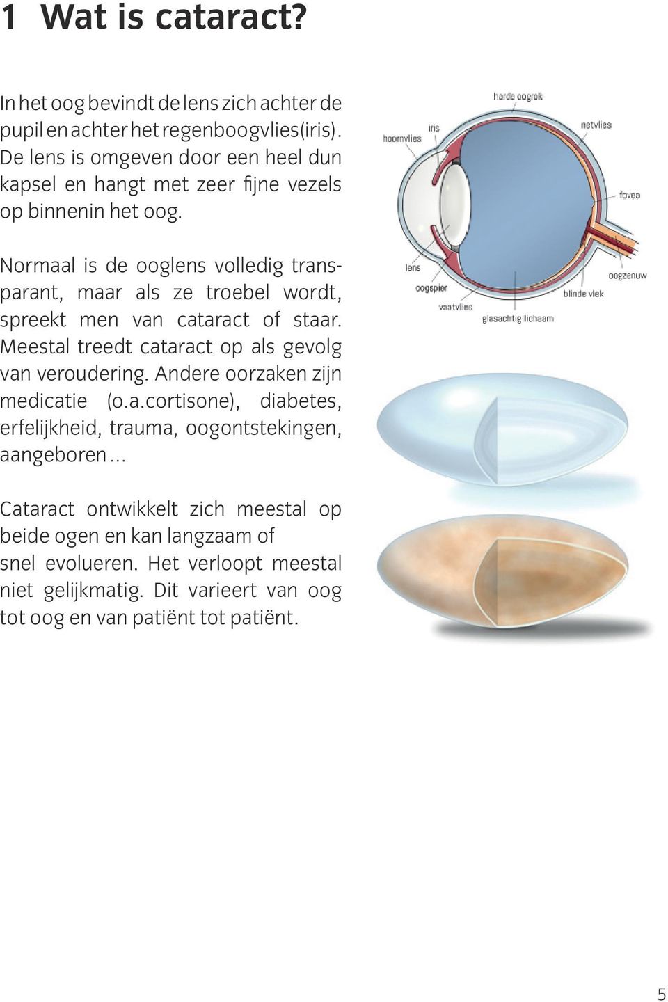 Normaal is de ooglens volledig transparant, maar als ze troebel wordt, spreekt men van cataract of staar. Meestal treedt cataract op als gevolg van veroudering.