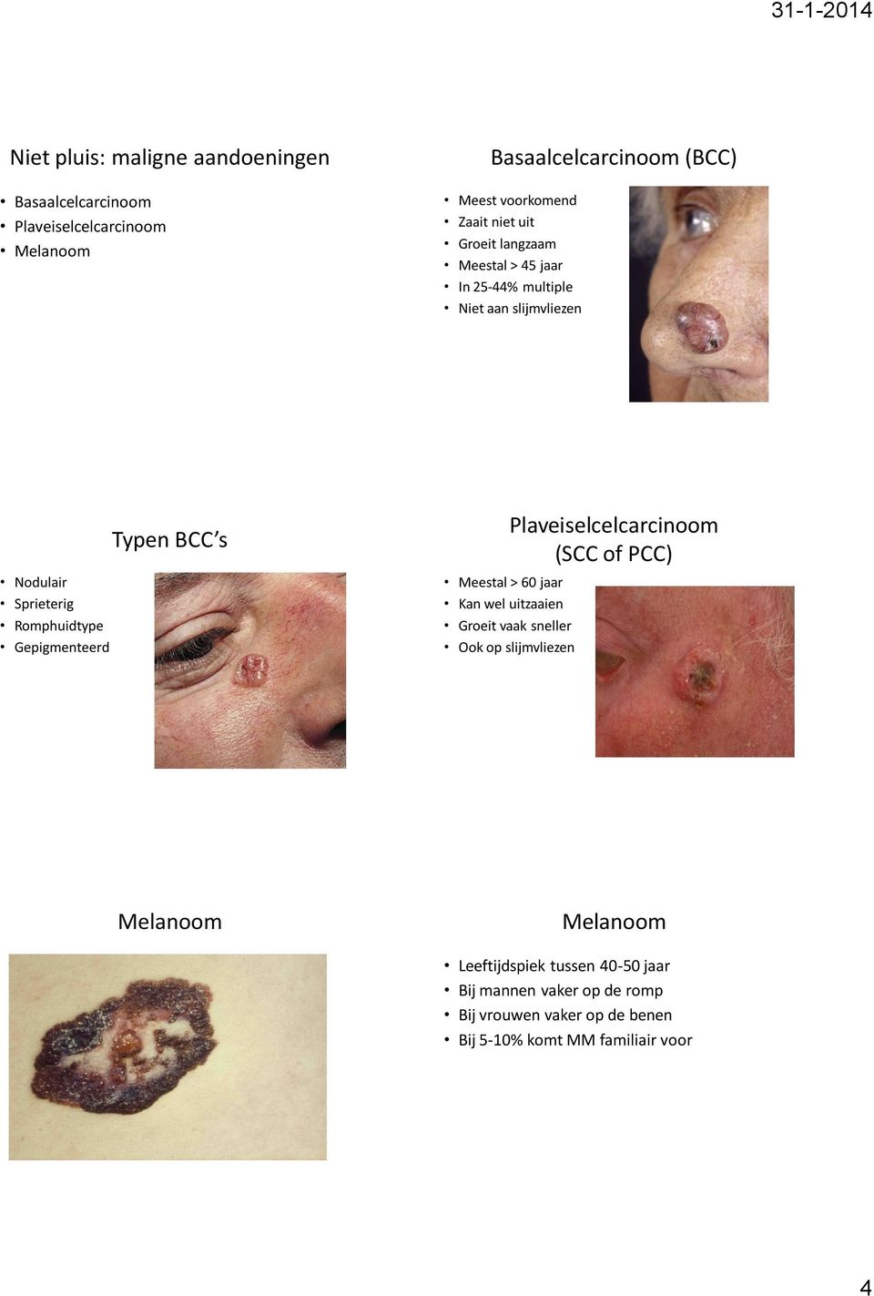 Typen BCC s Meestal > 60 jaar Kan wel uitzaaien Plaveiselcelcarcinoom (SCC of PCC) Groeit vaak sneller Ook op slijmvliezen Melanoom