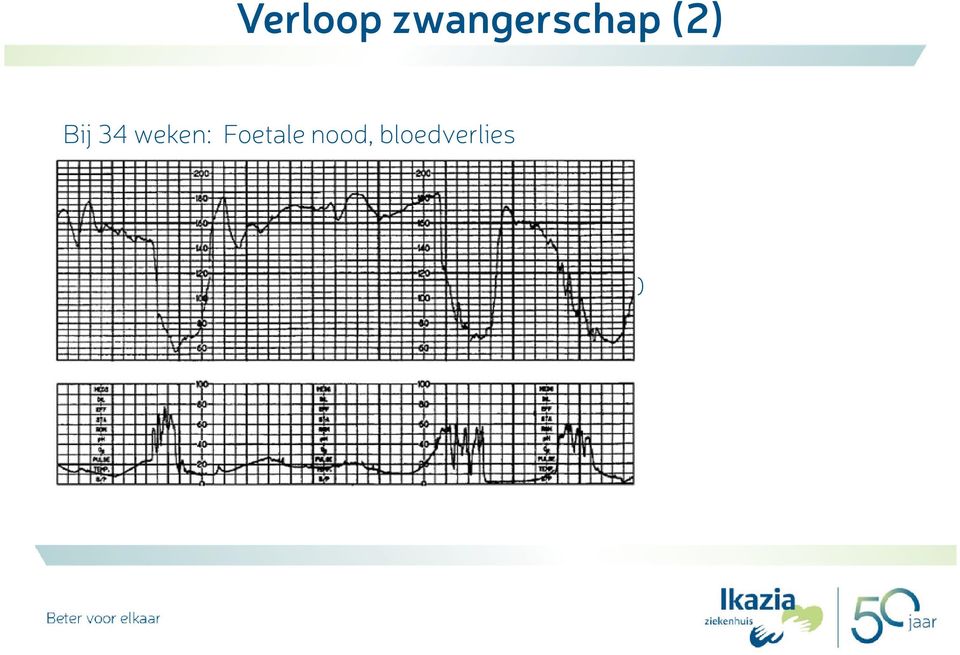 1200 gram, AS 3/7/10 Diagnose: Abruptio