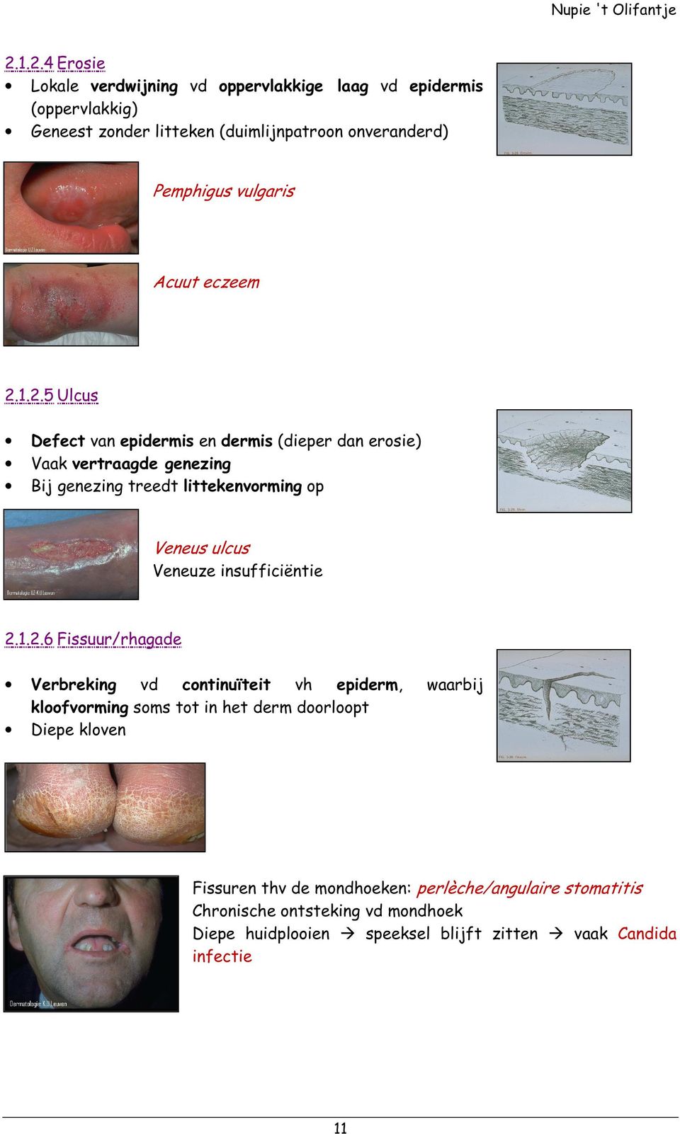 1.2.5 Ulcus Defect van epidermis en dermis (dieper dan erosie) Vaak vertraagde genezing Bij genezing treedt littekenvorming op Veneus ulcus Veneuze