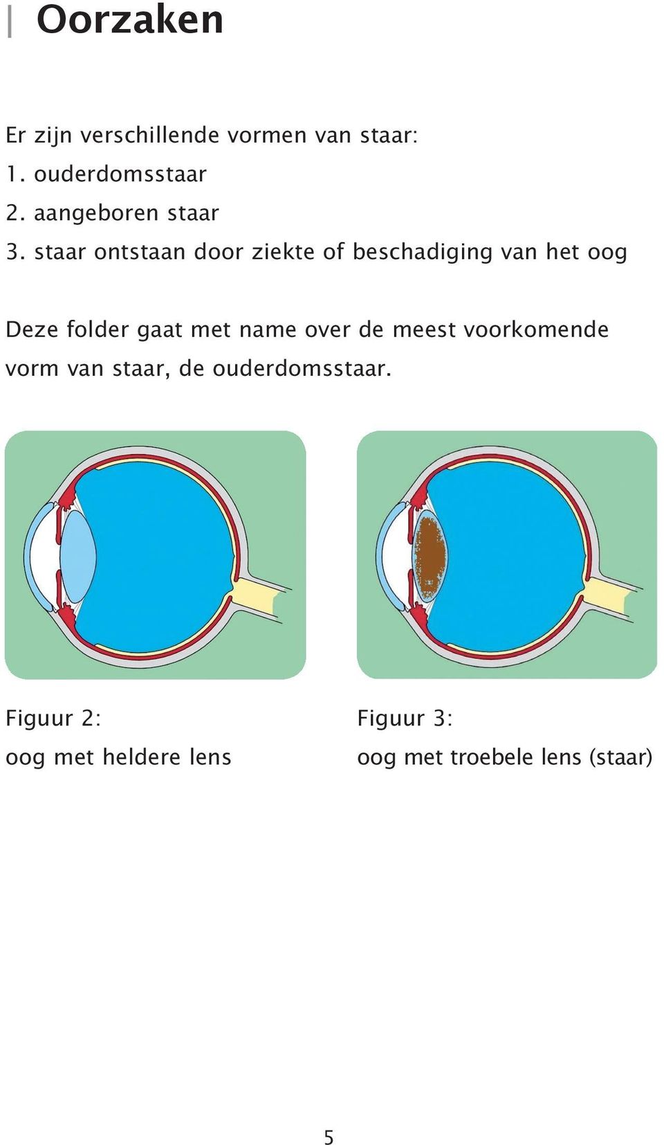 staar ontstaan door ziekte of beschadiging van het oog Deze folder gaat met