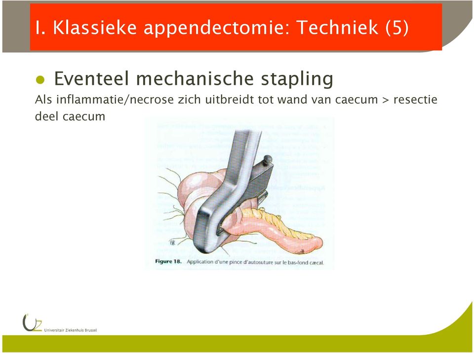 inflammatie/necrose zich uitbreidt