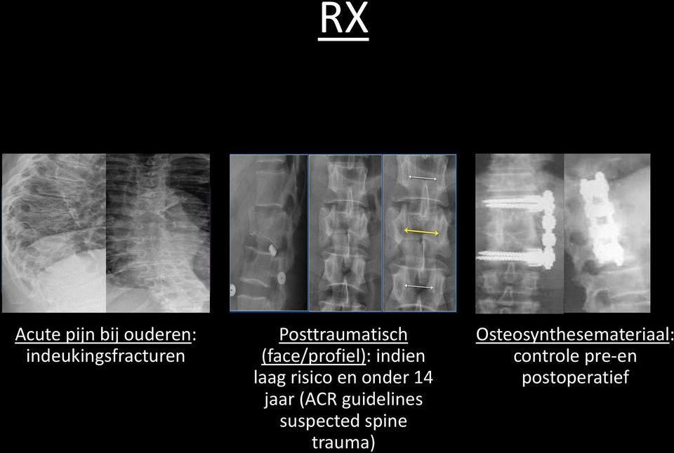 en onder 14 jaar (ACR guidelines suspected spine