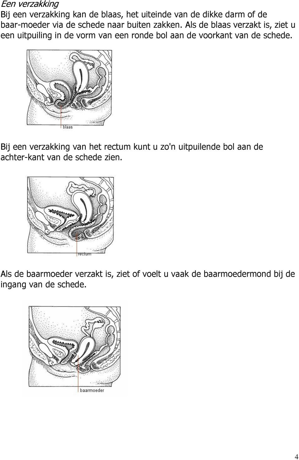 Als de blaas verzakt is, ziet u een uitpuiling in de vorm van een ronde bol aan de voorkant van de schede.