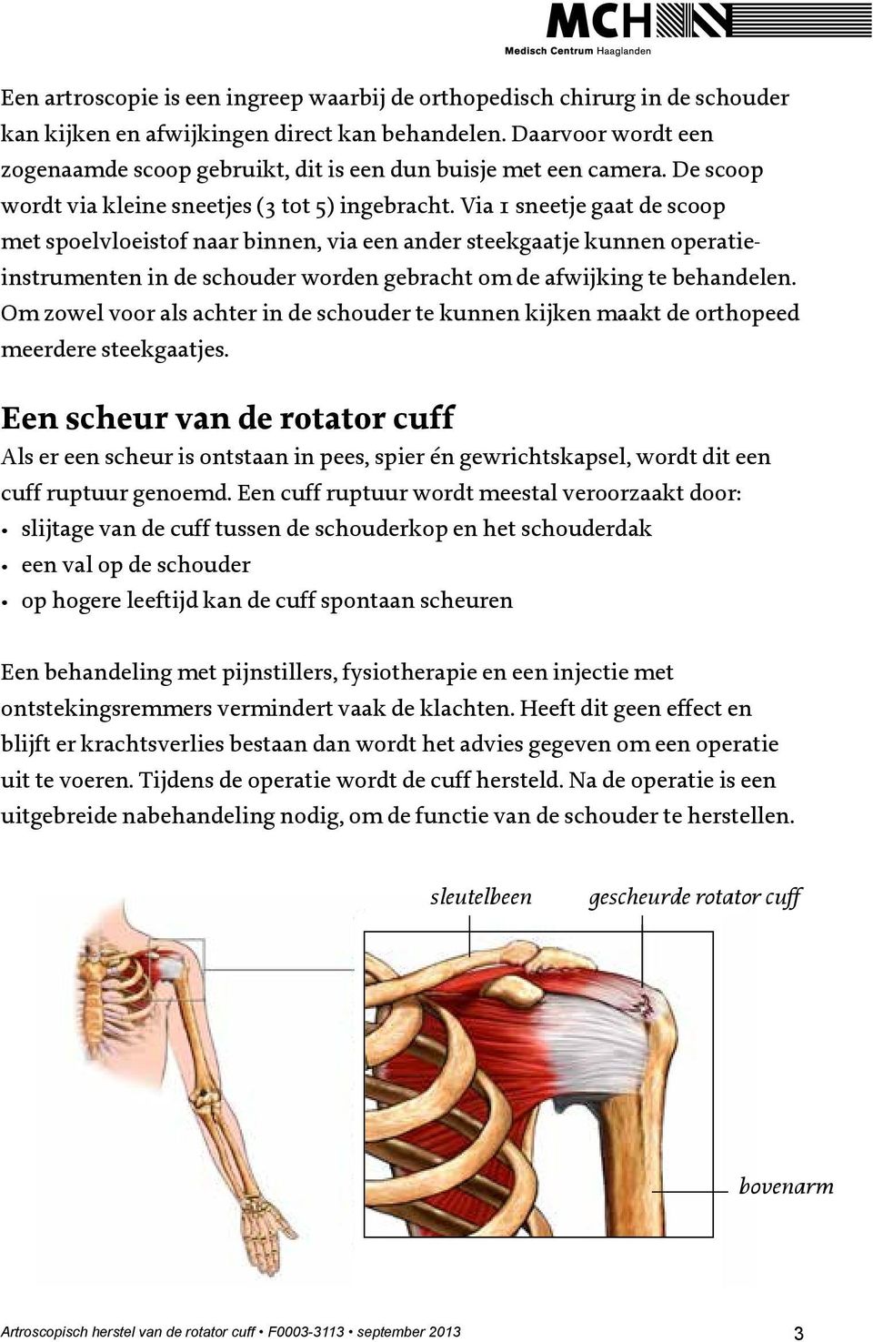 Via 1 sneetje gaat de scoop met spoelvloeistof naar binnen, via een ander steekgaatje kunnen operatieinstrumenten in de schouder worden gebracht om de afwijking te behandelen.