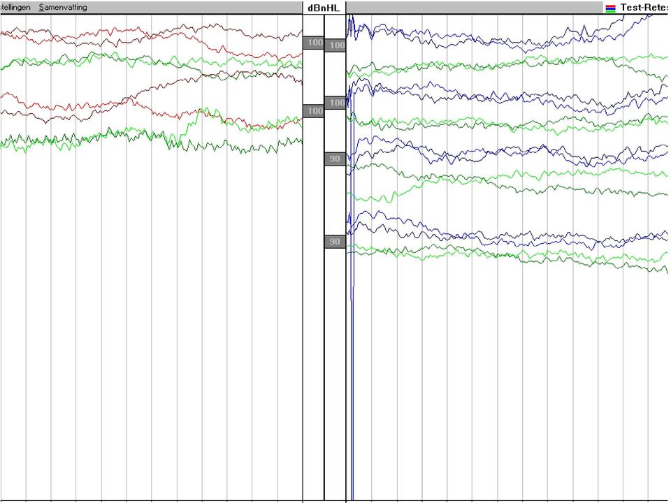 ??? Hoge tonen verlies van >90 db Neurale afwijking