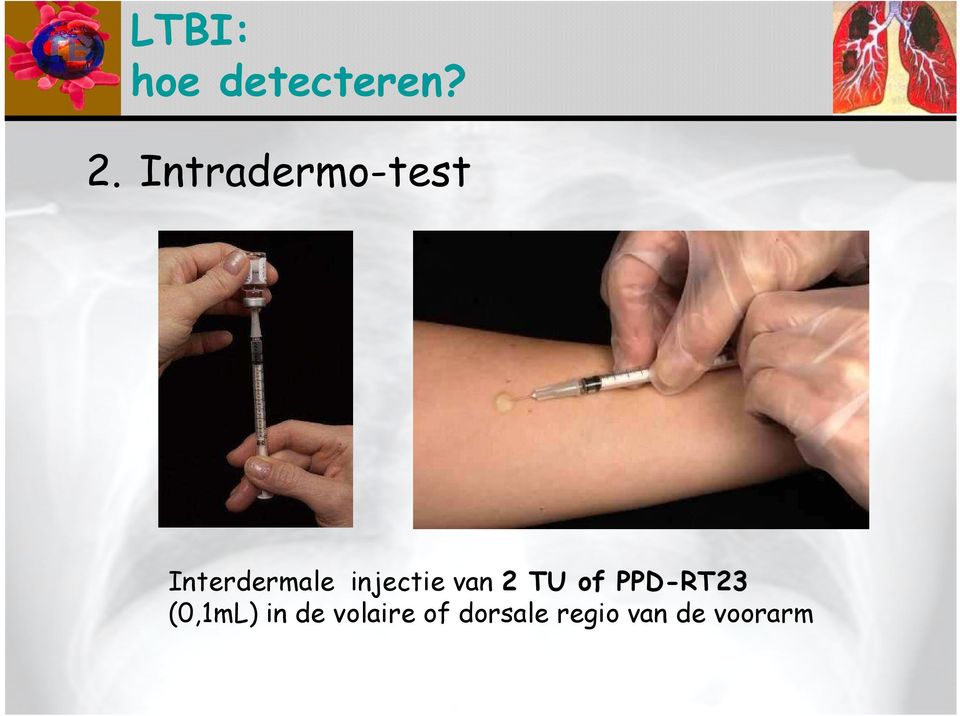 injectie van 2 TU of PPD-RT23