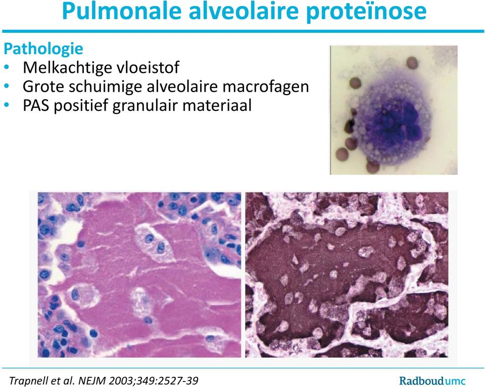 alveolaire macrofagen PAS positief