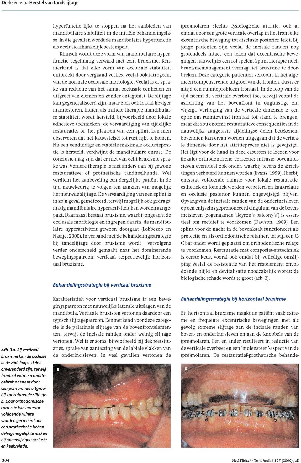 Kenmerkend is dat elke vorm van occlusale stabiliteit ontbreekt door vergaand verlies, veelal ook iatrogeen, van de normale occlusale morfologie.