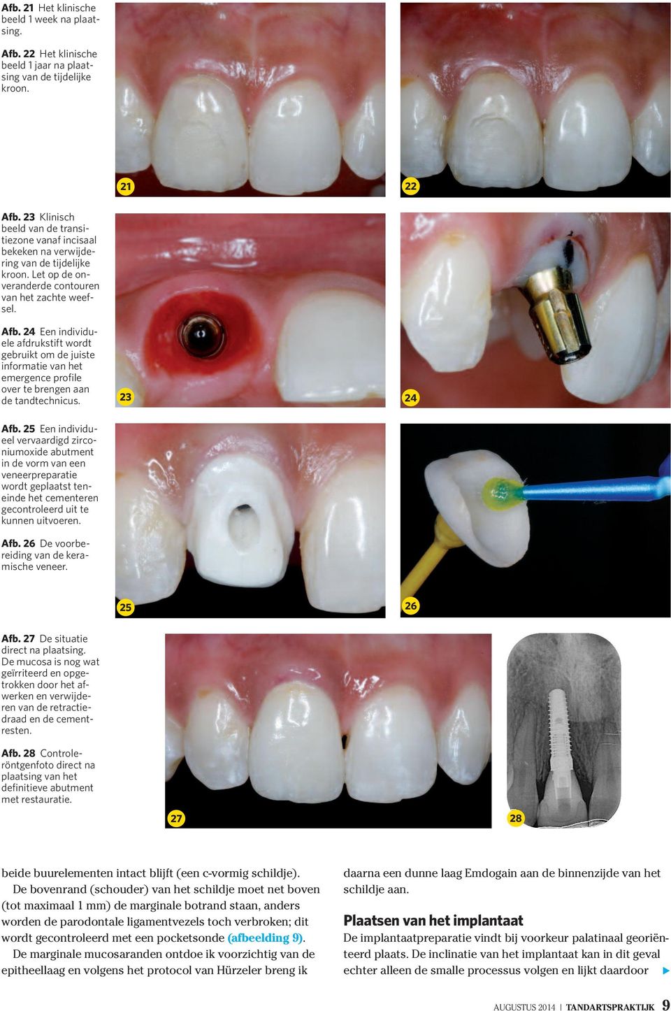 24 Een individuele afdrukstift wordt gebruikt om de juiste informatie van het emergence profile over te brengen aan de tandtechnicus. 23 24 Afb.