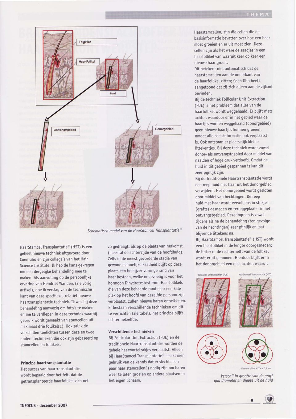 Als aanvutting op de persoontijke ervaring van HendriEt Wanders (zie vorig artiket), doe ik verstag van de technische kant van deze specifieke, retatief nieuwe haartransptantatie techniek.