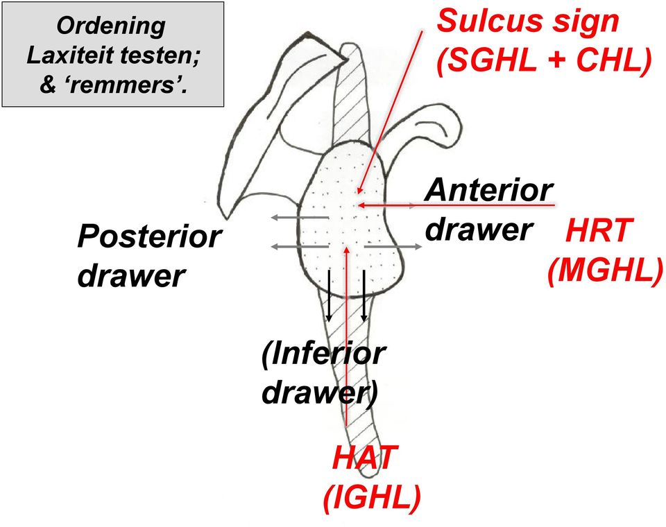 Sulcus sign (SGHL + CHL)