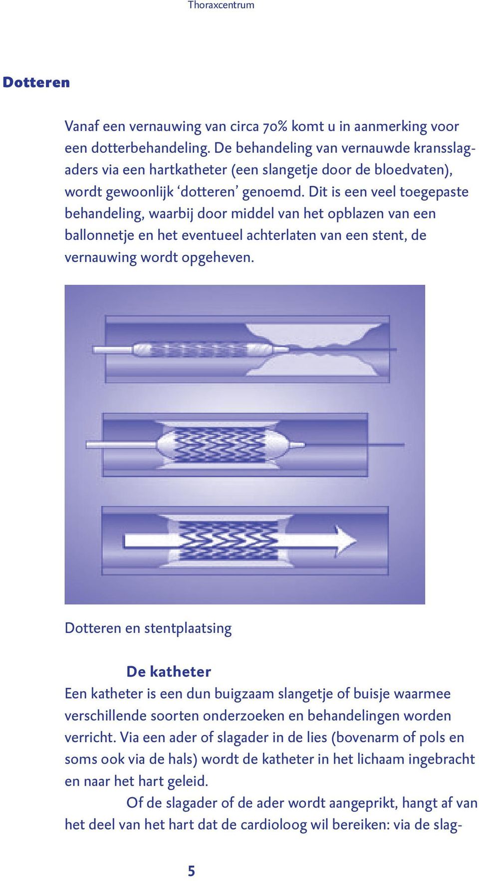 Dit is een veel toegepaste behandeling, waarbij door middel van het opblazen van een ballonnetje en het eventueel achterlaten van een stent, de vernauwing wordt opgeheven.