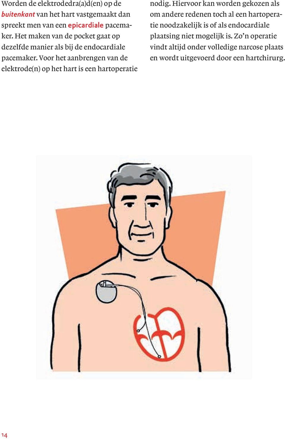 Voor het aanbrengen van de elektrode(n) op het hart is een hartoperatie nodig.