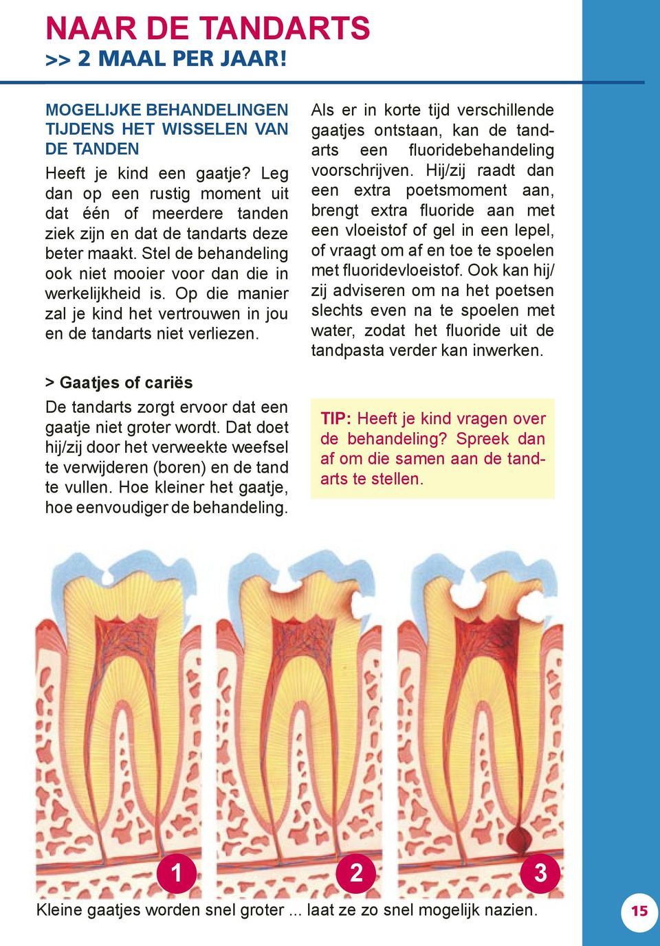 Op die manier zal je kind het vertrouwen in jou en de tandarts niet verliezen. > Gaatjes of cariës De tandarts zorgt ervoor dat een gaatje niet groter wordt.