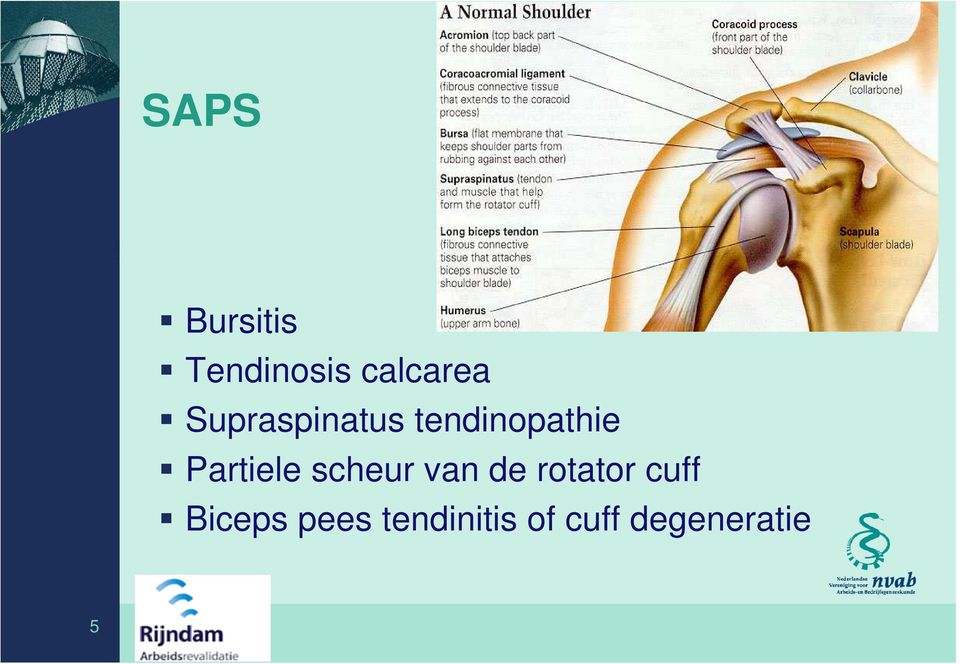 Partiele scheur van de rotator cuff