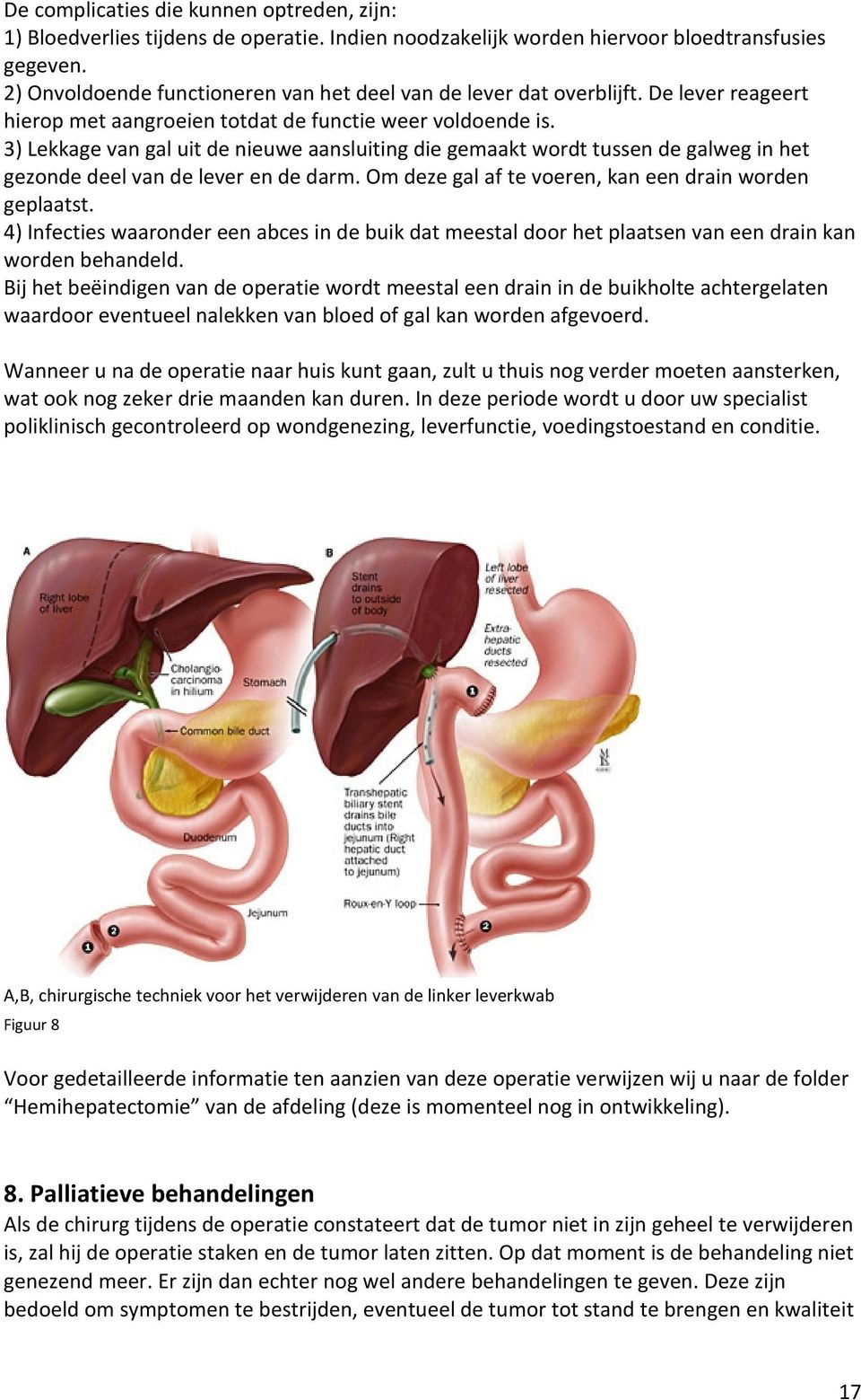 3) Lekkage van gal uit de nieuwe aansluiting die gemaakt wordt tussen de galweg in het gezonde deel van de lever en de darm. Om deze gal af te voeren, kan een drain worden geplaatst.