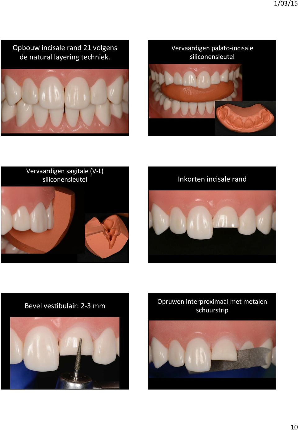 sagitale (V- L) siliconensleutel Inkorten incisale rand Bevel