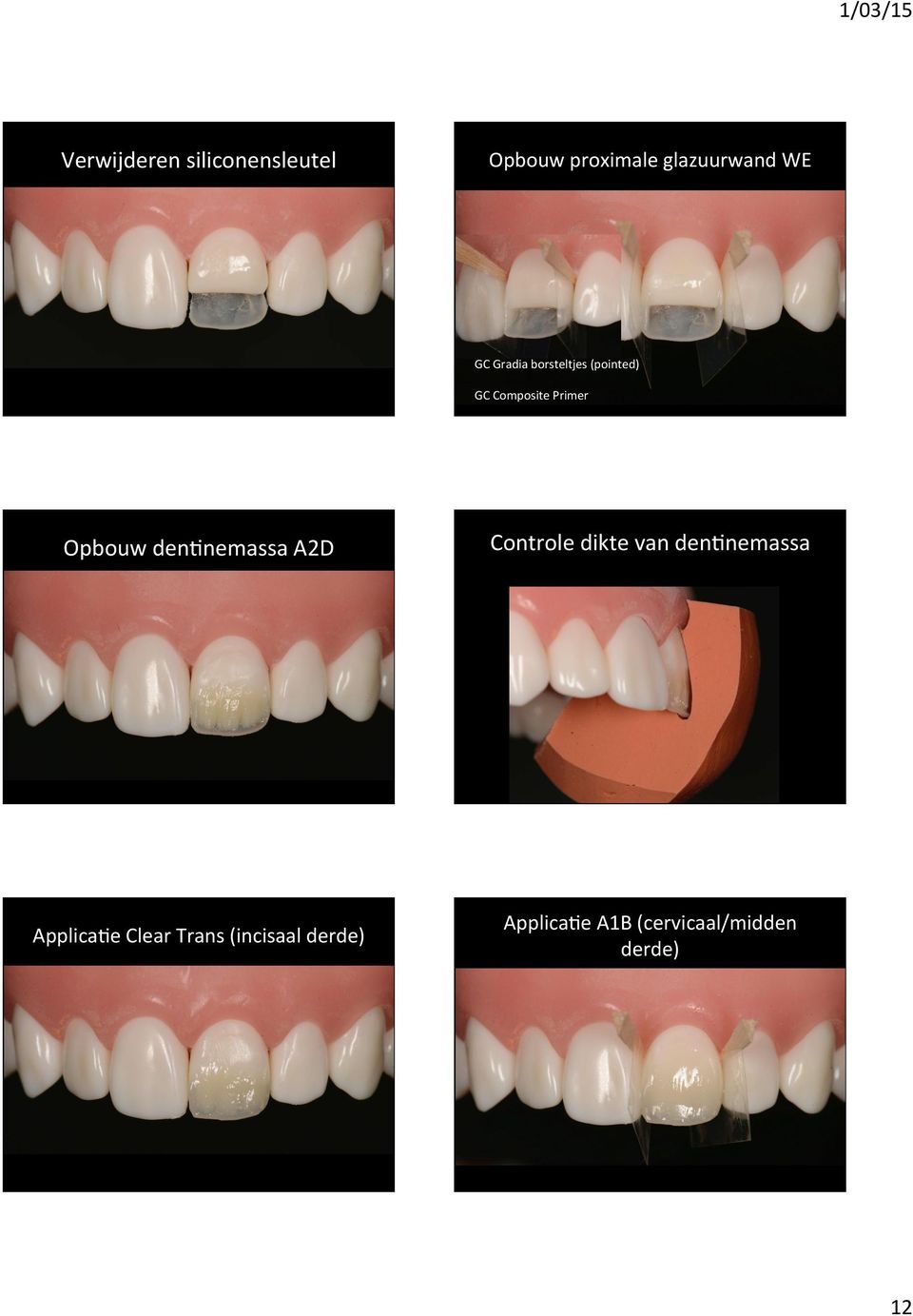 dentnemassa A2D Controle dikte van dentnemassa ApplicaTe