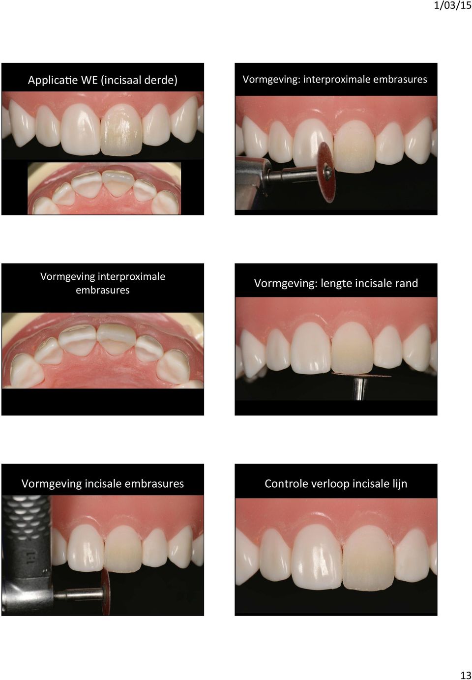 : lengte incisale rand Vormgeving incisale