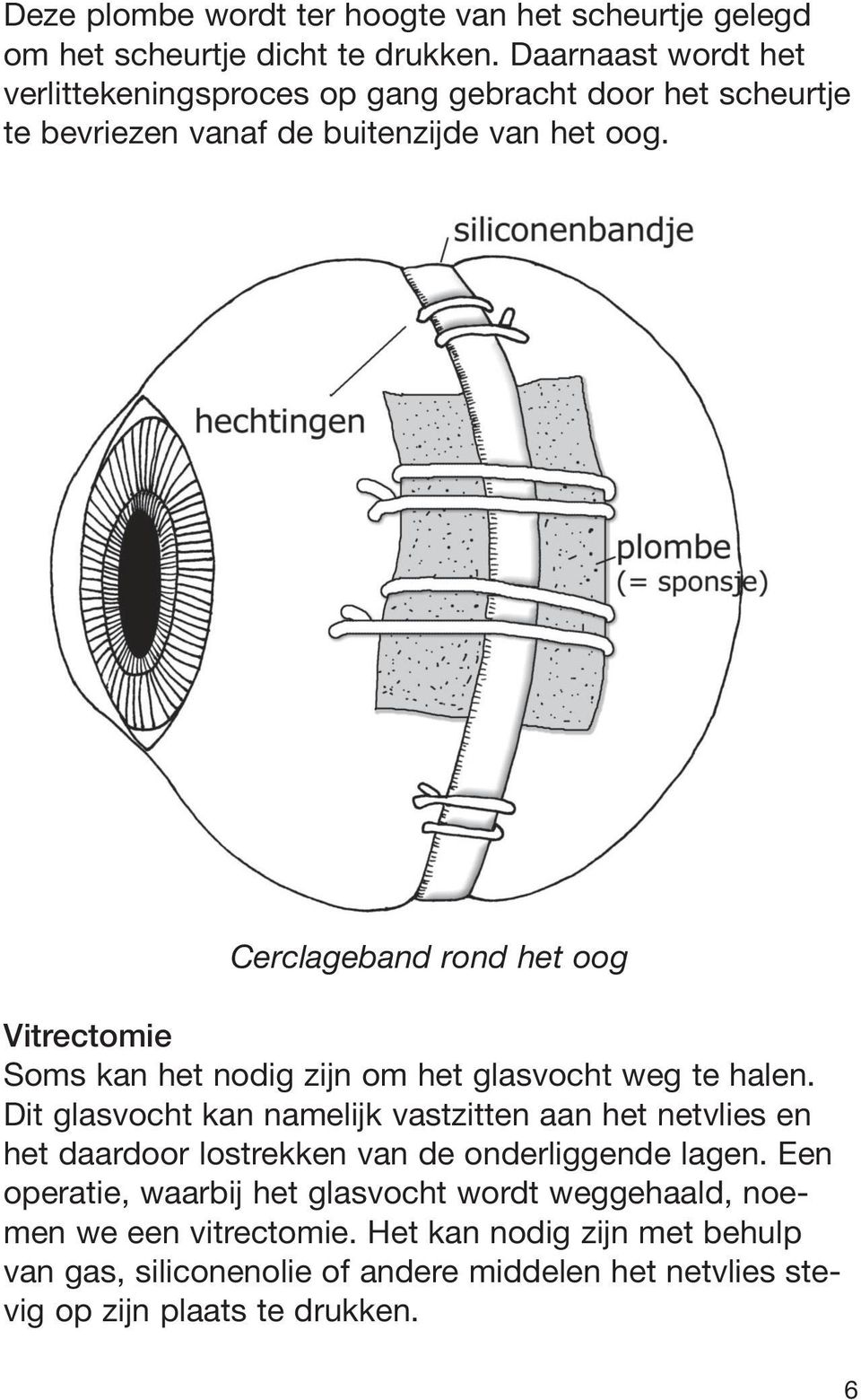 Cerclageband rond het oog Vitrectomie Soms kan het nodig zijn om het glasvocht weg te halen.