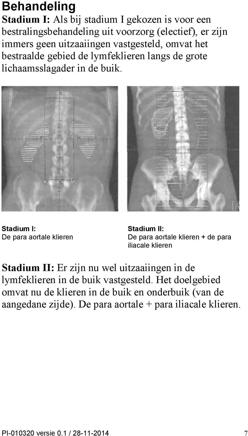 Stadium Ι: De para aortale klieren Stadium ΙΙ: De para aortale klieren + de para iliacale klieren Stadium ΙΙ: Er zijn nu wel uitzaaiingen in de