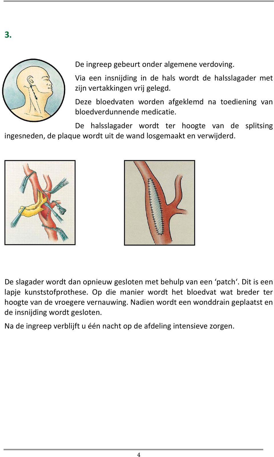 De halsslagader wordt ter hoogte van de splitsing ingesneden, de plaque wordt uit de wand losgemaakt en verwijderd.