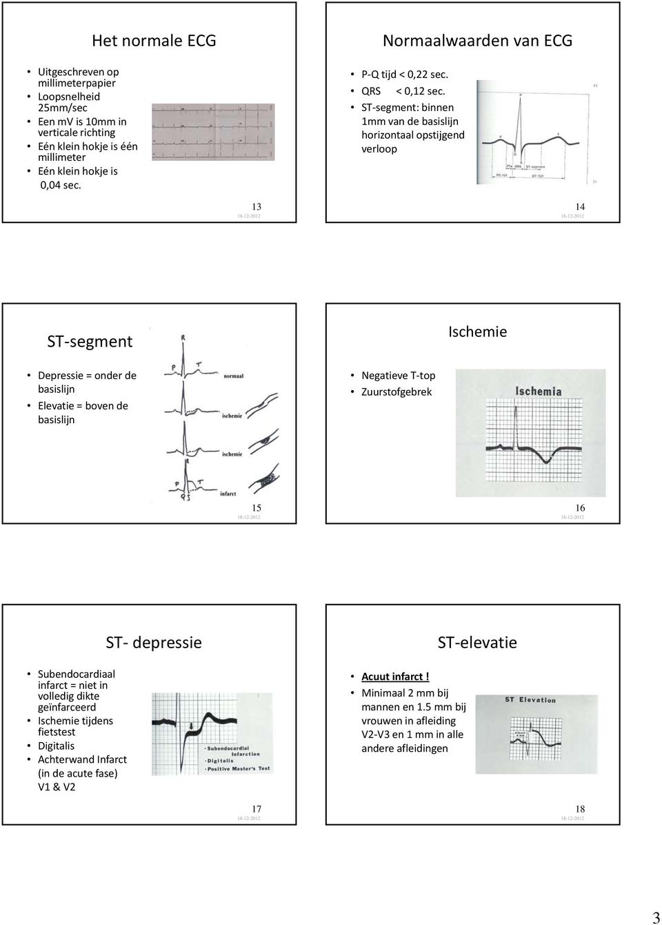 ST segment: binnen 1mm van de basislijn horizontaal opstijgend verloop 13 14 ST segment Ischemie Depressie = onder de basislijn Elevatie = boven de basislijn Negatieve T top