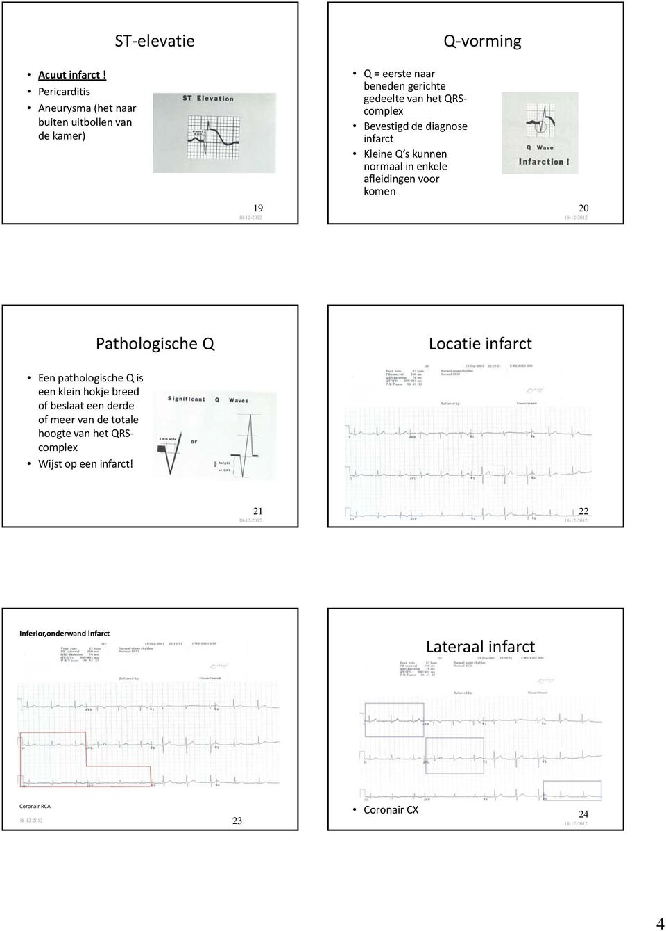 complex Bevestigd de diagnose infarct Kleine Q s kunnen normaal in enkele afleidingen voor komen 20 Pathologische Q Locatie