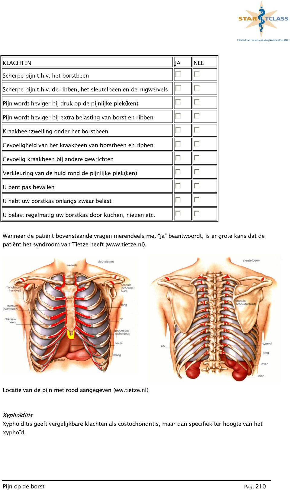 de ribben, het sleutelbeen en de rugwervels Pijn wordt heviger bij druk op de pijnlijke plek(ken) Pijn wordt heviger bij extra belasting van borst en ribben Kraakbeenzwelling onder het borstbeen